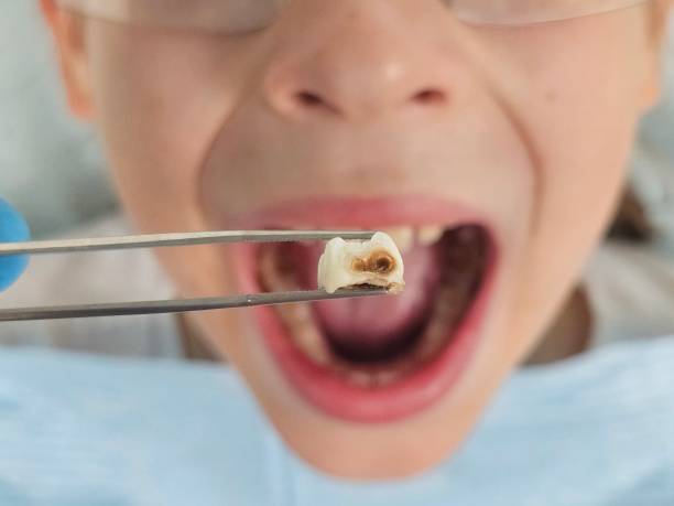 Best Broken or Chipped Tooth Repair in Northlake, TX